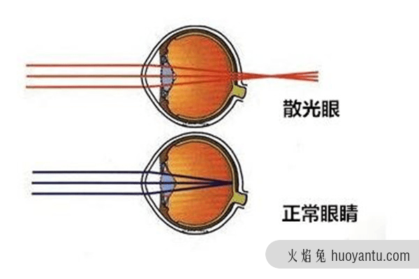 散光是怎么造成的 人为什么会发生散光