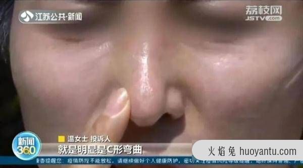 女子鼻头右偏去整形，没想到修成了整个鼻子朝左歪