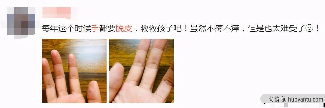 你的手为什么老脱皮？原因竟不是缺维生素