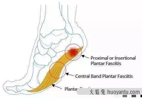 足底筋膜炎的预防、治疗和恢复，看这篇就够了