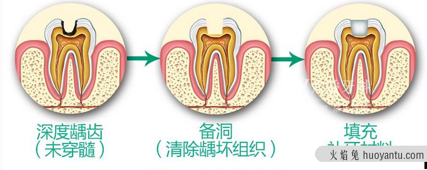 补牙可以保持多久呢？