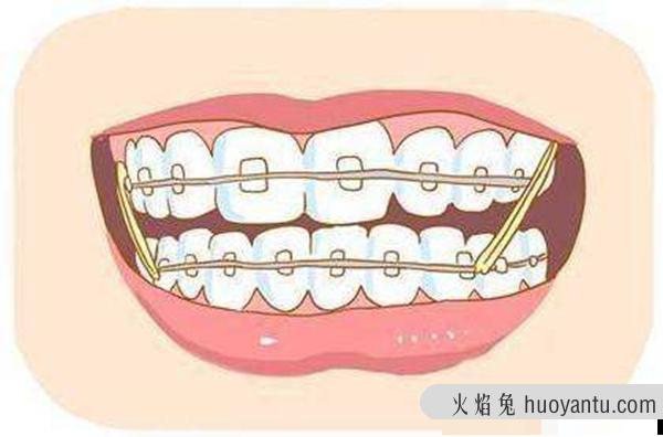 矫正牙齿对以后有影响吗?矫正牙齿利与弊有哪些?